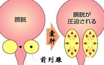 前列腺囊肿危害有哪些
