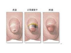 包茎有哪些具体表现?