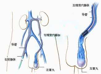 男性精索静脉曲张可以治愈吗