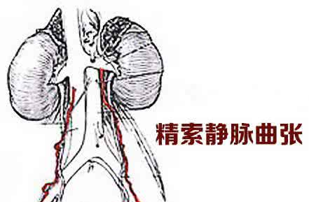 精索静脉曲张会影响怀孕吗?